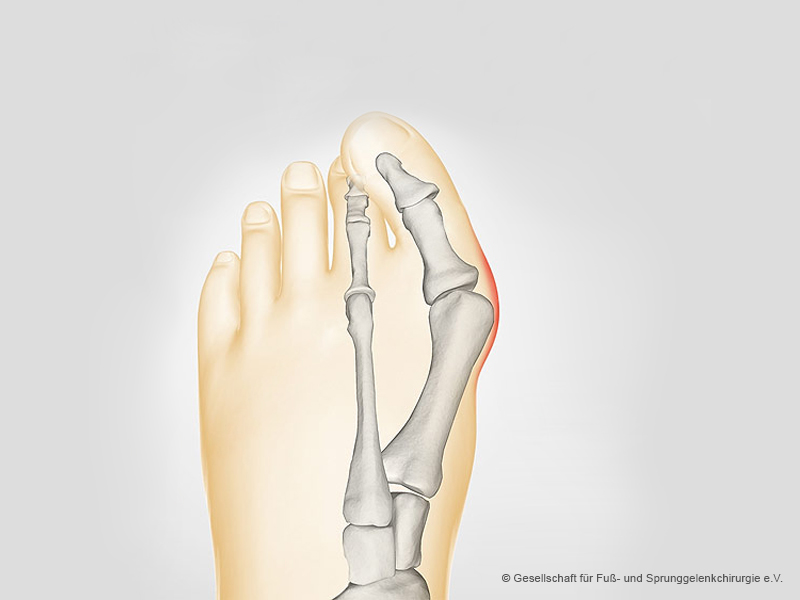 Startseite, Fuß- und Sprunggelenkchirurgie