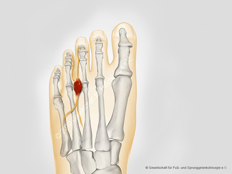 Morton Neuralgie Gesellschaft Fur Fuss Und Sprunggelenkchirurgie E V