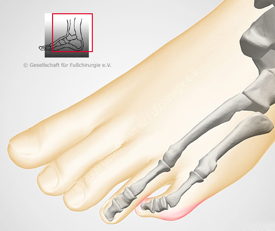 fußschmerzen außenseite kleiner zeh - www.listaso.com.
